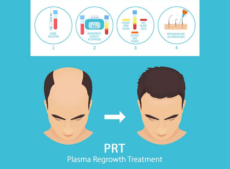 Red Deer PRP Therapy - Plasma Hair Regrowth | Innovation Dermatology